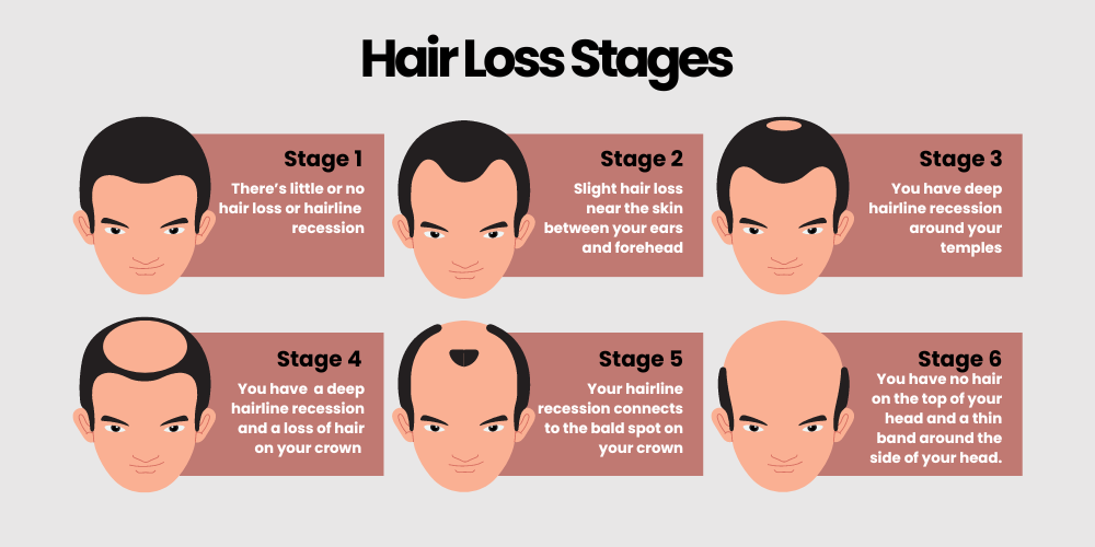 6 stages of hair loss - buy cheap hair loss treatment online in the UK