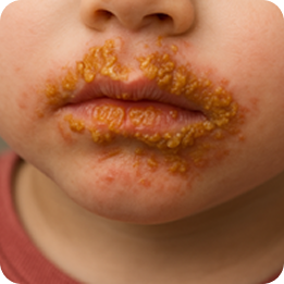 impetigo example