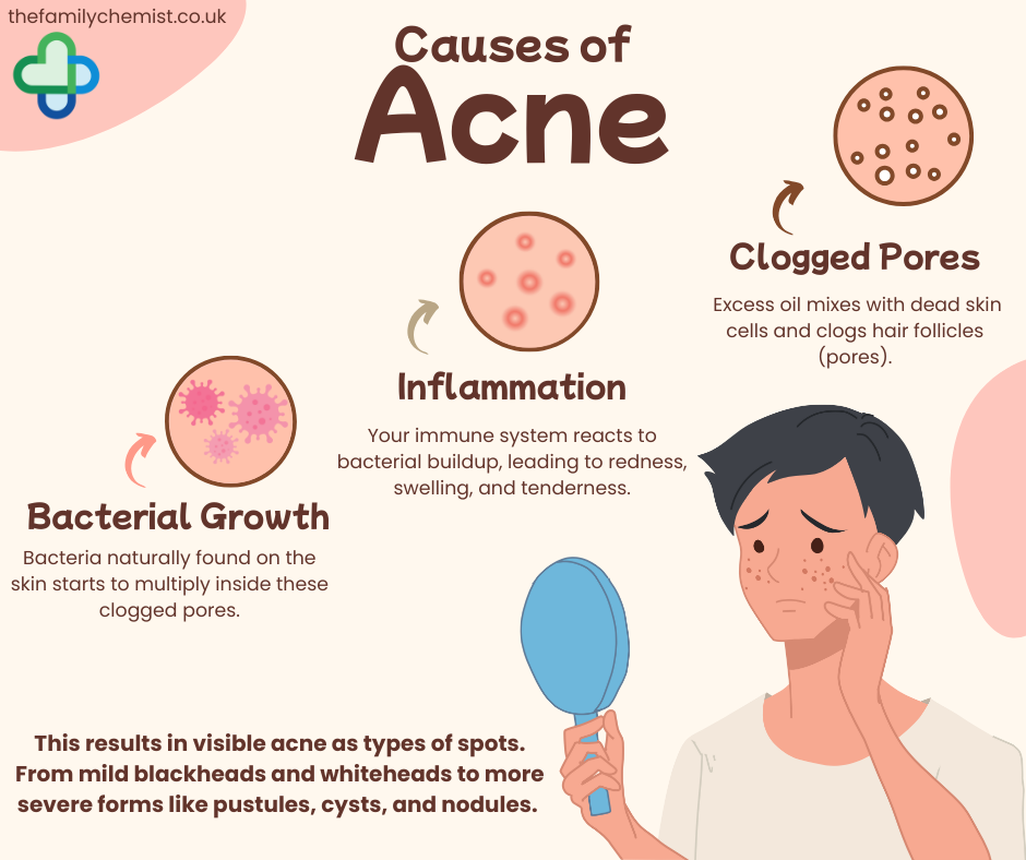 causes of acne infographic 