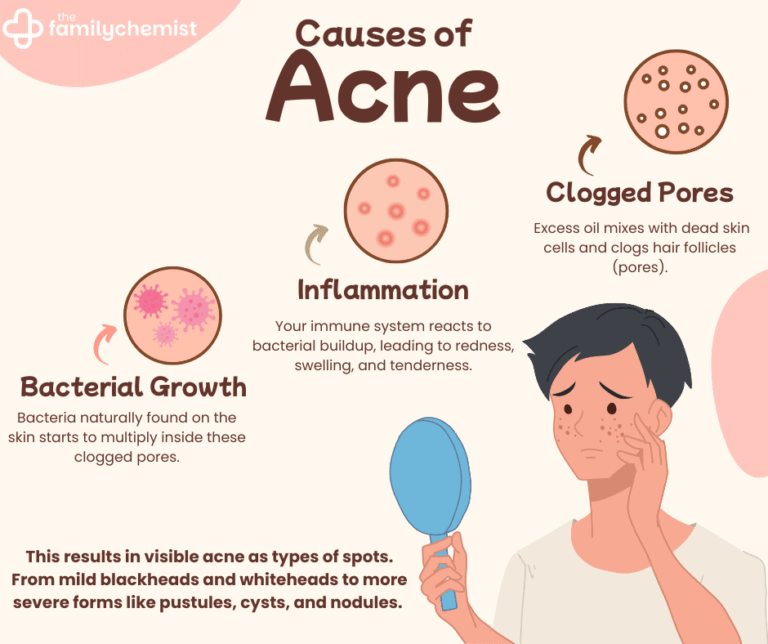 why-am-i-getting-acne-in-my-20s-30s-the-family-chemist