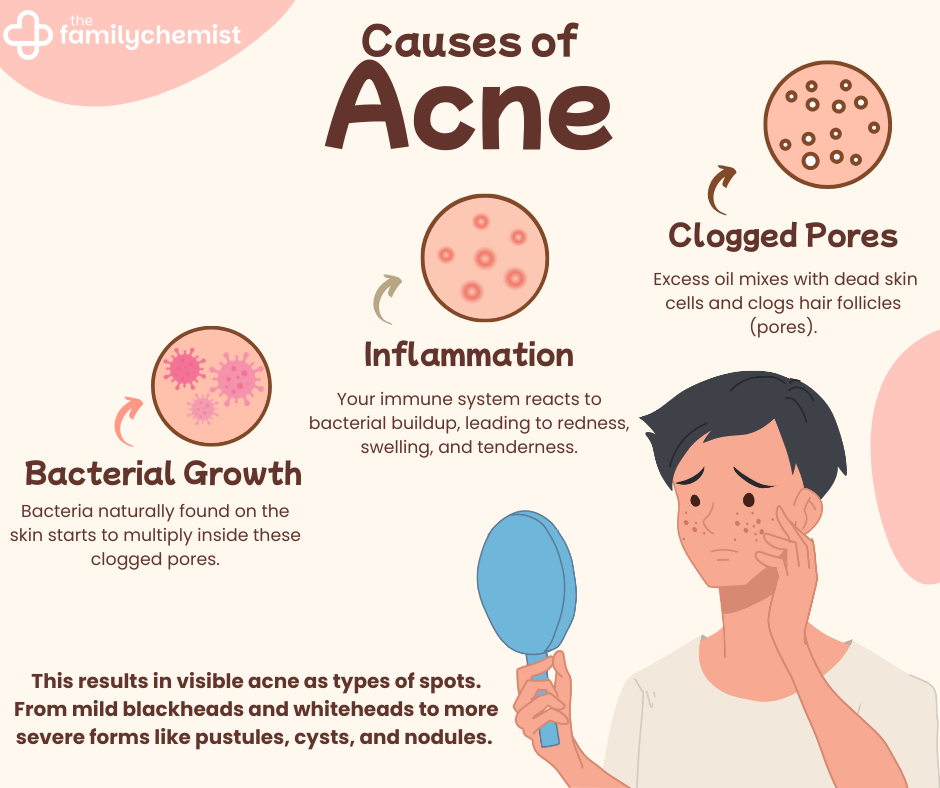 causes of acne infographic