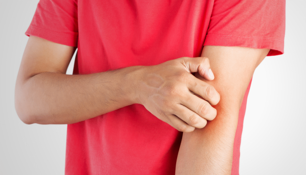 eczema steroid treatments banner